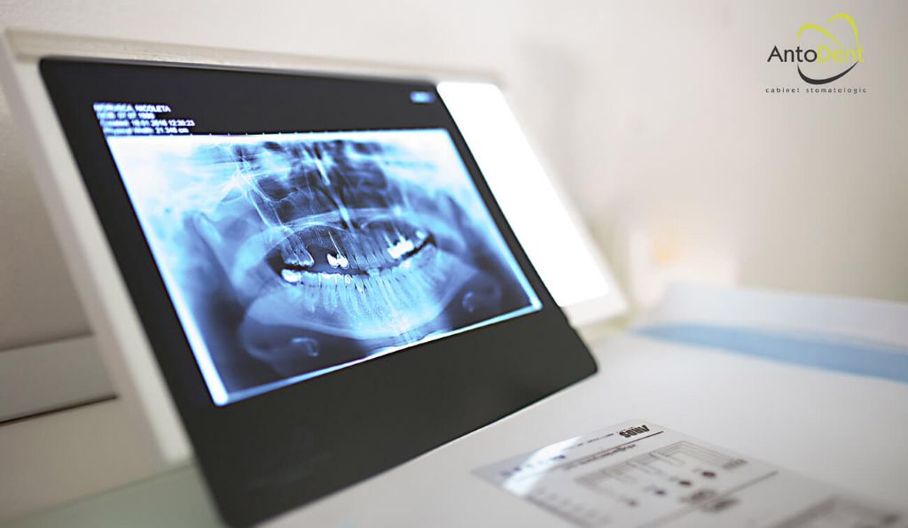 Radiografie dentară